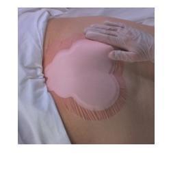 MEDICAZIONE IDROCELLULARE ADESIVA STERILE CONFORMATA PER LA REGIONE SACRALE ASSORBENTE IN SCHIUMA DI POLIURETANO ALLEVYN SACRUM 22,5X22,1CM 10PZ - Pharmaleader